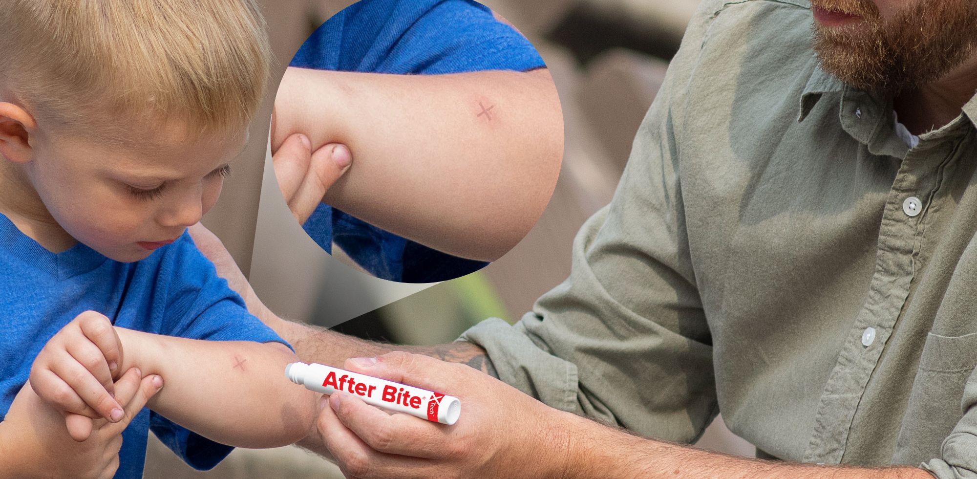 Man using After Bite X-Tech on little boy with close up of X on arm