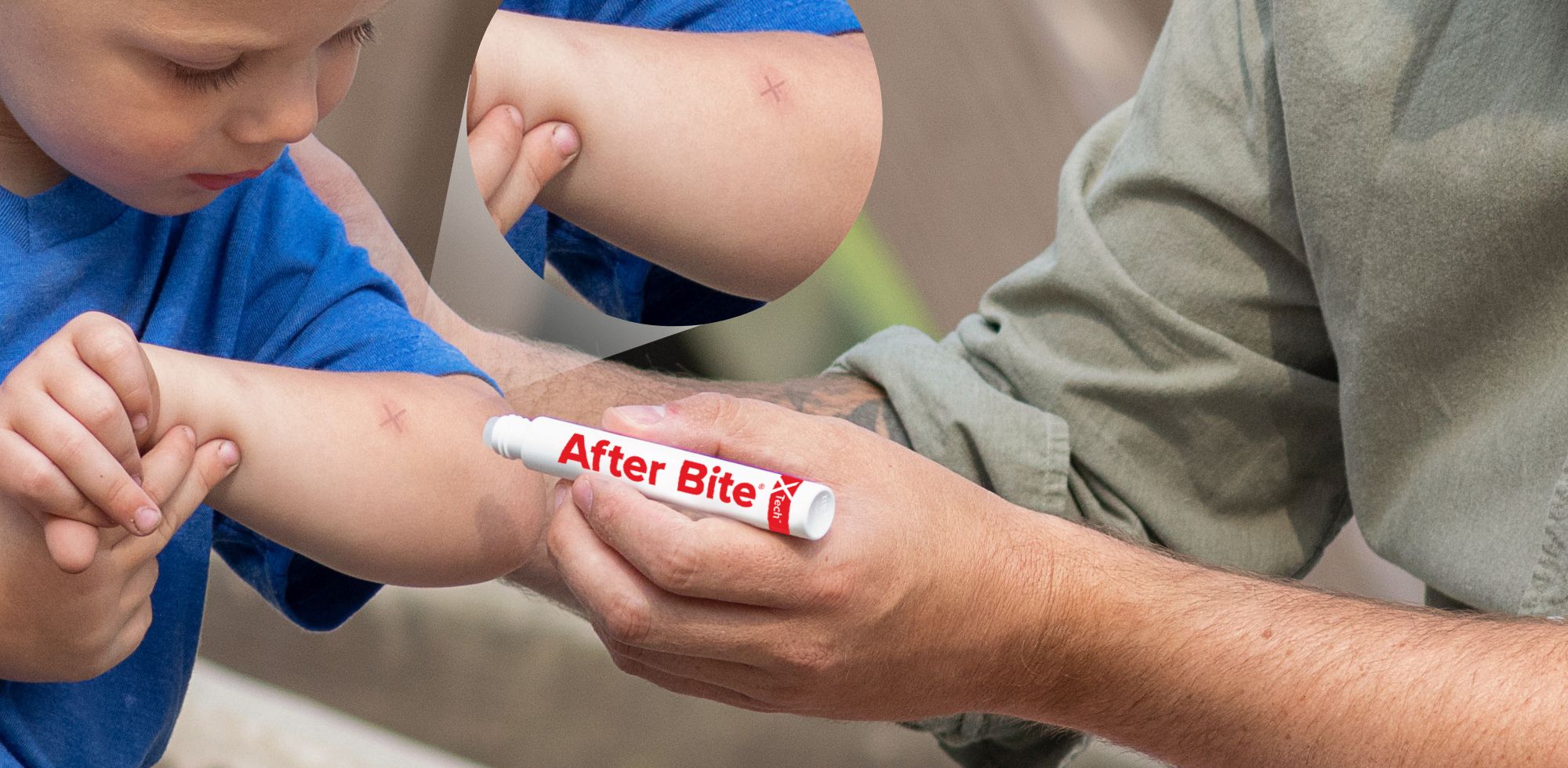 Man using After Bite X-Tech on little boy with close up of X on arm